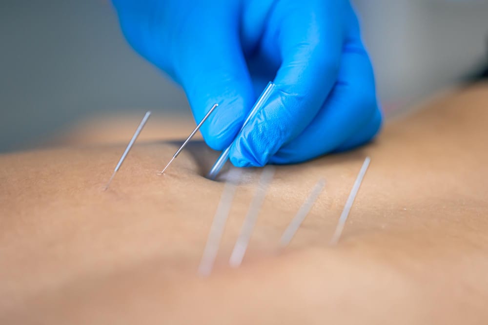 Dry needling treatment